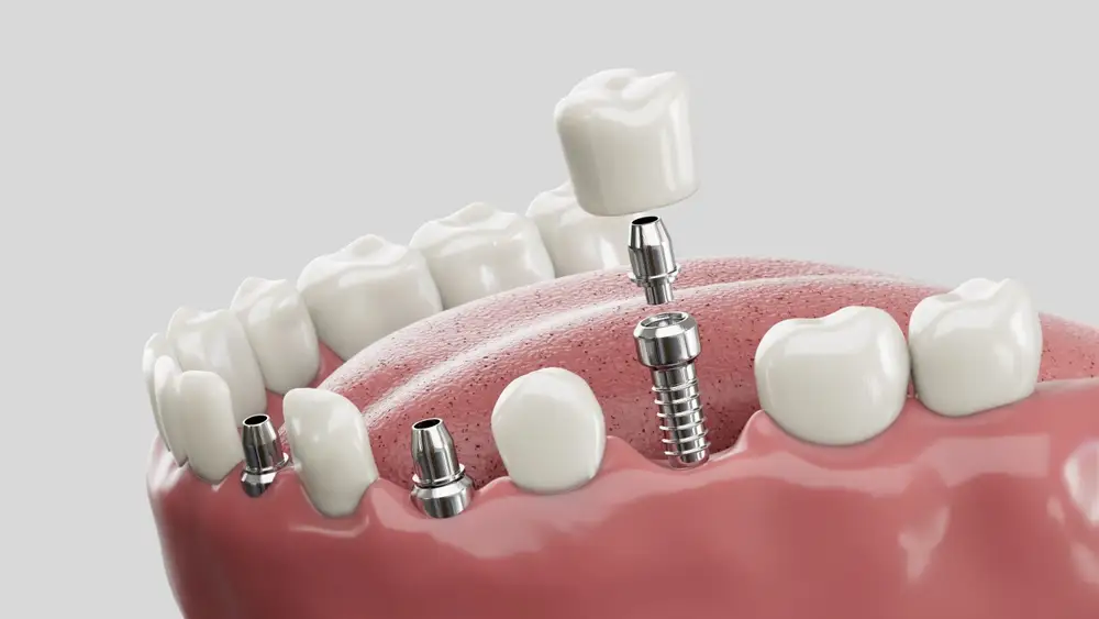 dental implants treatment Thane