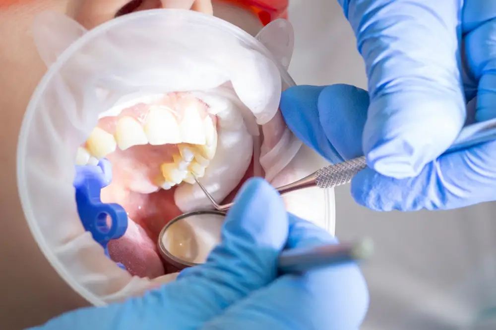 Root Canal Treatment in Thane